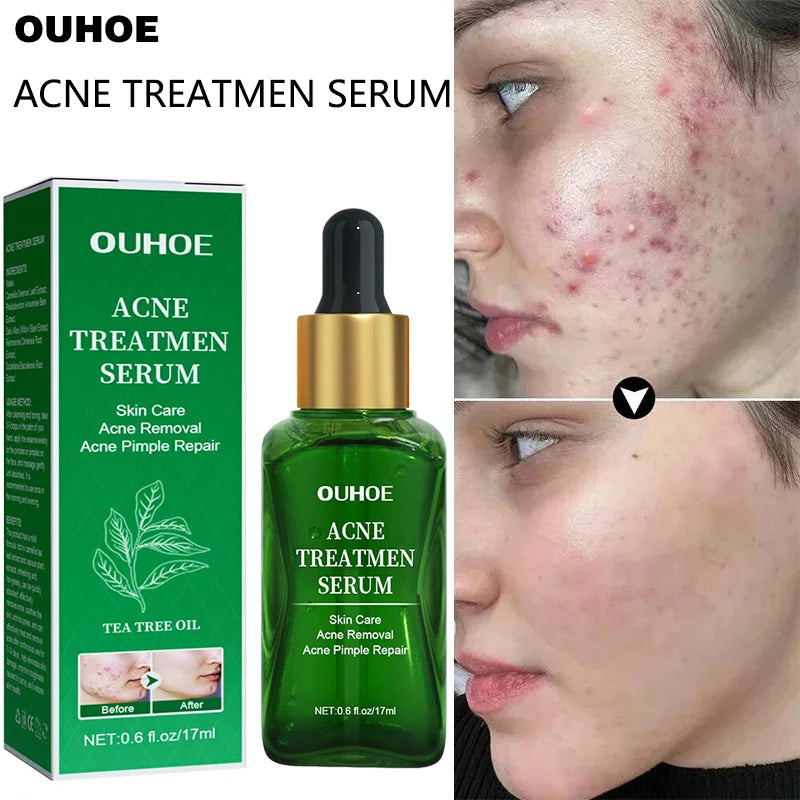 Acne Treatment Facial Serum Pore Shrinking Skin Care