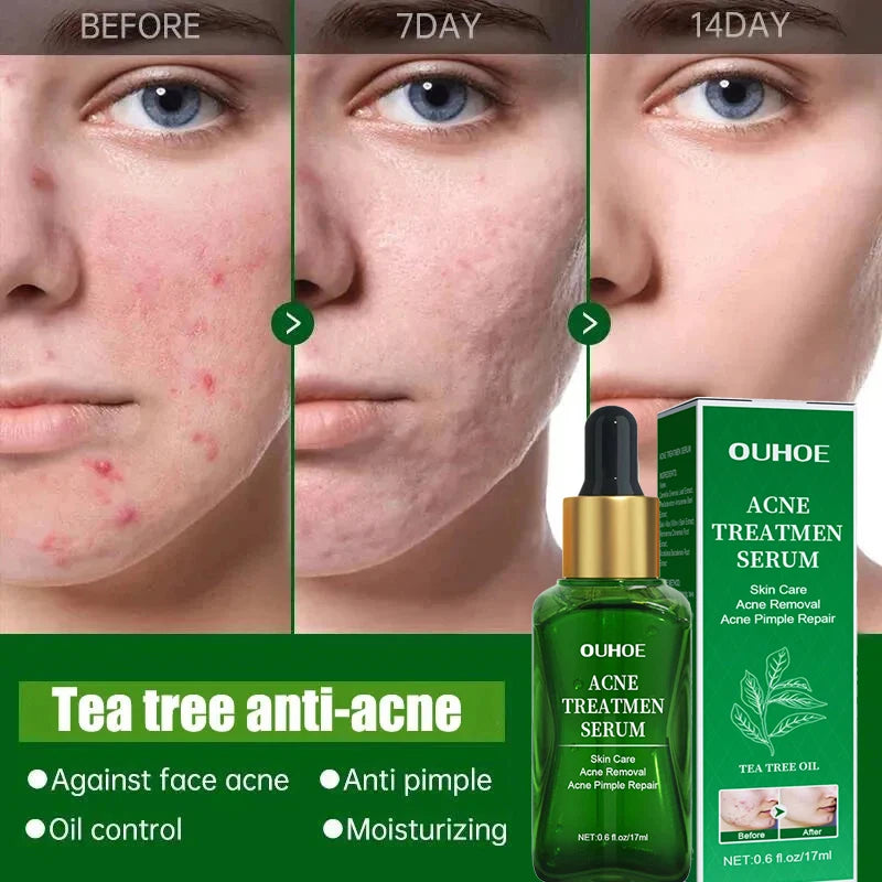 Acne Treatment Facial Serum Pore Shrinking Skin Care